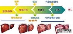 肝硬化和肝衰竭有区别吗？